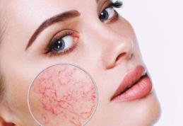 Roșeață pe față: care sunt cauzele