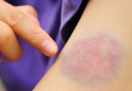 Semnele care anunță leucemia: care sunt persoanele cu risc