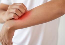 Informații despre boala numită dermatomiozită