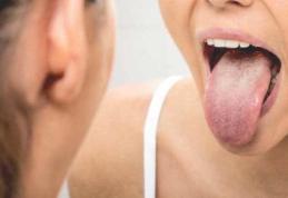 Ce afecțiune poți avea dacă ai limba încărcată de depozite albicioase sau gălbui