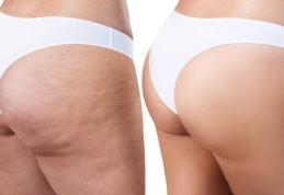Remediu mai puțin știut pentru celulită