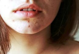 Efectele consumului de zahăr în exces