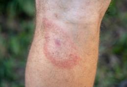 Câteva semne de avertizare că aveți boala Lyme transmisă de căpușe