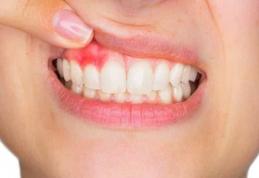 Retețe naturale de oprire a sângerărilor gingivale