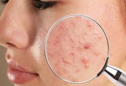 Cauza neașteptată a apariției coșurilor