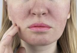 Rozaceea - ce este şi cum se manifestă