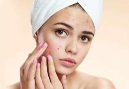 Cum să scapi de acnee cu remedii naturale