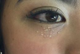 Cum elimini punctele albe? 