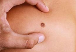 Ce faci când ți se rupe o aluniță