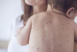 Lista județelor cele mai afectate de epidemia de rujeolă