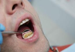 Sfaturi pentru a elimina tartrul dentar în mod natural