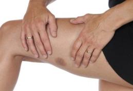 Tratamente naturale ale contuziilor