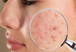 Ceaiuri recomandate pentru combaterea acneei