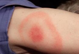 Semne de avertizare că ai boala Lyme transmisă de căpușe