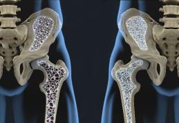 Riscul de osteoporoză și seleniul. Ce legatură există