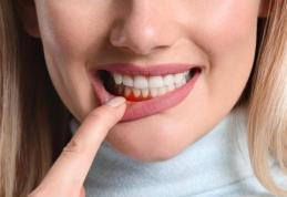 Boala gingiilor. Simptome, cauze și tratamente