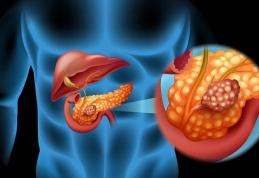 Molecula care distruge cancerul pancreatic