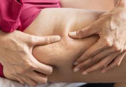 Dieta care ne poate scăpa de celulită