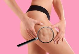 Informații importante despre lupta cu celulita, în mod natural