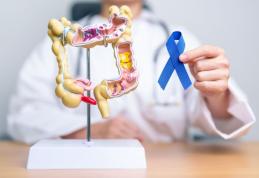 Polipii de colon, sursa de cancer. Cât de des trebuie făcută colonoscopia