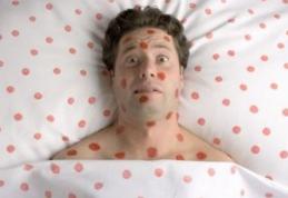 Epidemia de rubeolă amenință România