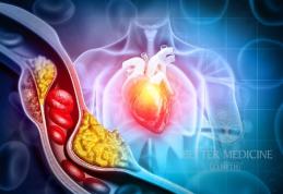 Simptome în cazul arterelor înfundate