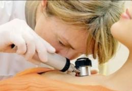 Alunițele canceroase devin periculoase la ultraviolete