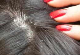 Cum să scapi de mătreață