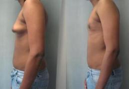 Cât de dăunător este consumul de carne de pui injectată cu hormoni