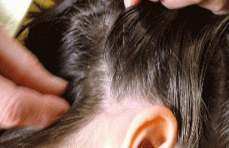 Mediul urban în topul rușinii! Adolescenți găsiți cu păduchi la început de an școlar