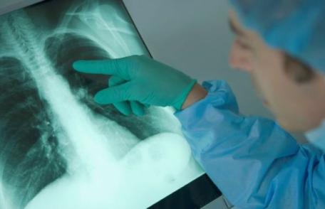 Un semn banal arată cancerul de plămâni încă din stadiu incipient