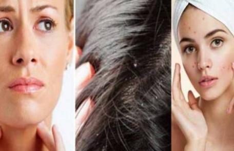 Cu un singur ingredient vindeci roșul în gât, te scapă de mătreață și de coșuri