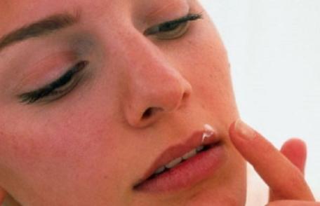 Așa scapi de herpes, cu ce ai în casă