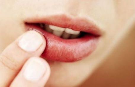 Cum să scapi de herpes simplu şi rapid