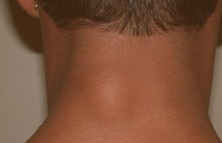 Ce este lipomul și când trebuie operat