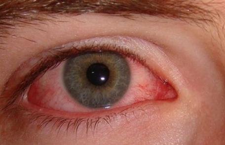 Mierea, remediu naturist pentru conjunctivită