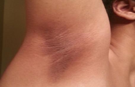 Cum scapi de pielea neagră de pe coate, genunchi sau subraț. Remedii naturiste