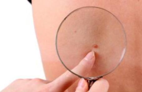 Medicii trag un semnal de alarmă: Ce sunt, de fapt, aluniţele roşii care apar pe corp