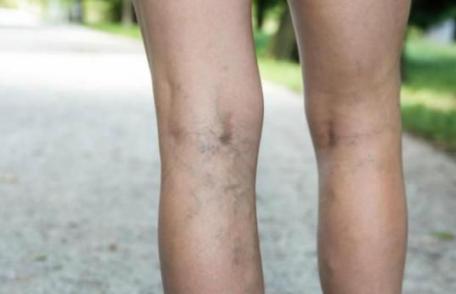 Mai mult de jumătate dintre românce suferă de varice. Iată de ce!