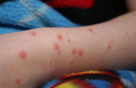 Trei copii din Dorohoi au ajuns la spital cu rujeolă după ce mama lor a refuzat să îi vaccineze