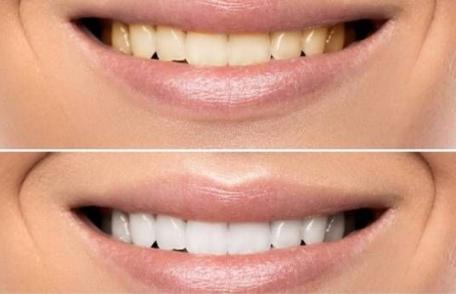 Cât de periculos este tartrul