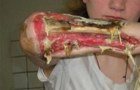 Crocodil, drogul care mănâncă dependenții, a ajuns în Europa