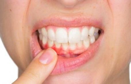 Tratamente din plante pentru abces dentar