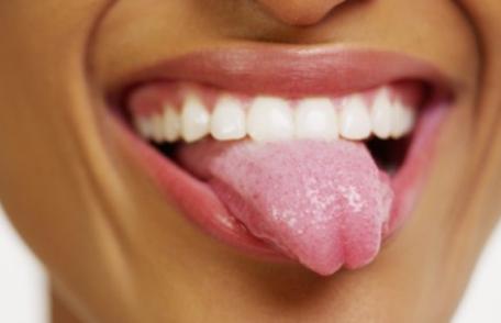 Cauze posibile pentru culoarea albă a limbii