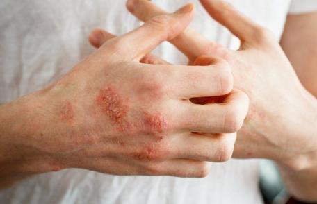 O boală de piele extrem de dureroasă este agravată de stres