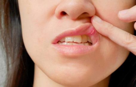 Remedii naturiste te scapă imediat de afte