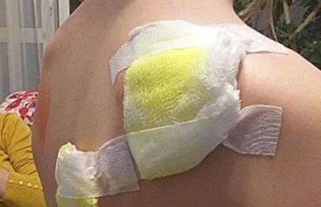 Revoltător! Doi adulți și o fetiță de 11 ani mușcate de un câine la Botoșani - FOTO