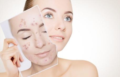 Acneea – Soluții naturale pentru a scăpa de ea