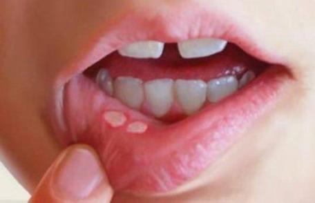 Cum intervenim în caz de aftoză