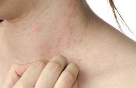 Cum recunoaștem și cum tratăm alergia la căldură